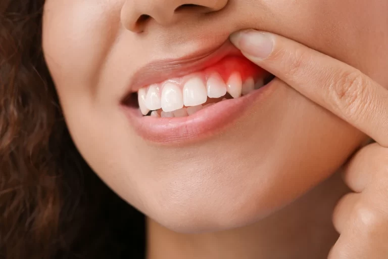 What Does a Healing Gum Look Like?