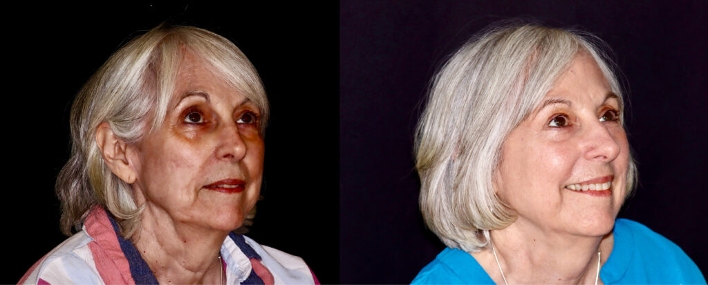 Woman before and after Opus Plasma treatment