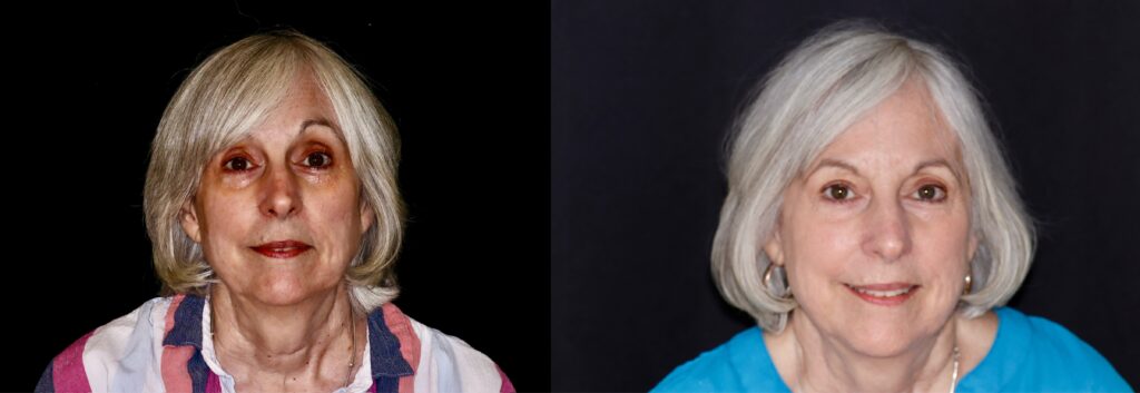 Woman before and after Opus Plasma treatment