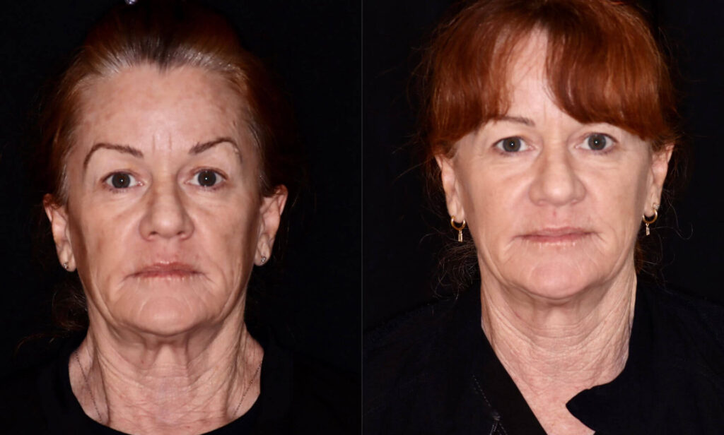 Women's face before and after Opus Plasma treatment