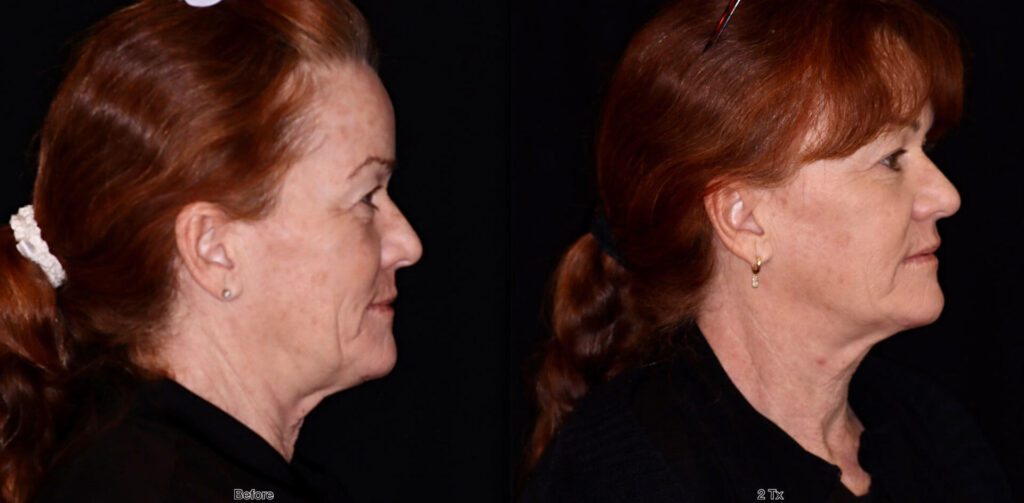 Woman before and after Opus Plasma treatment, side view