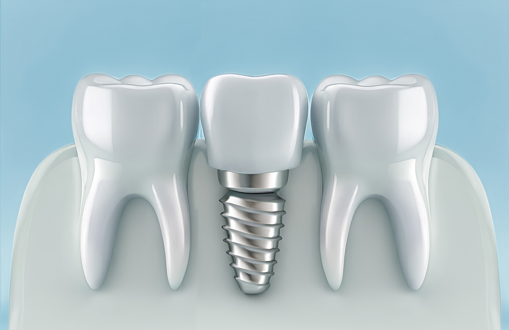 Dental implant between natural teeth