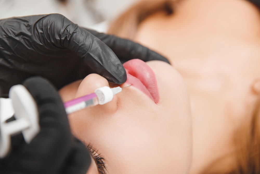female lips, lip augmentation procedure. A syringe near a woman's mouth, injections to increase the shape of the lips