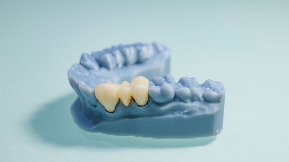 The zirconia crown bridge denture placed on the patient's tooth model is blue in color. Photographed against a white background.