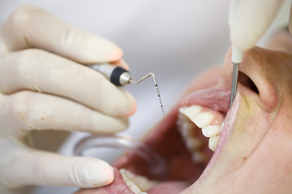 Periodontal probe, held by dental hygienist, measuring pocket depths around tooth, examining progression of periodontal disease.